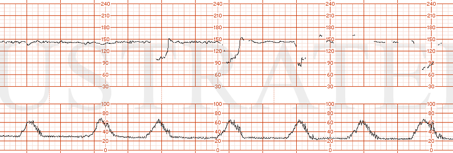 STRIP 119 1. Category II -- baseline 145, minimal variability, occasional variable decelerations and loss of tracing Toco: every 2 minutes