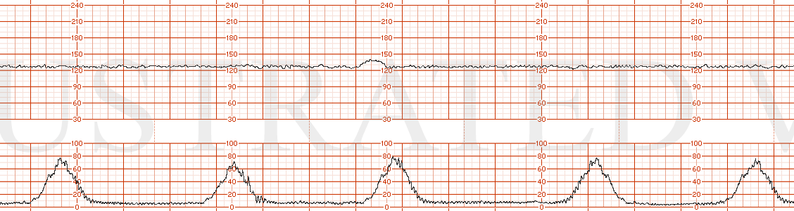 STRIP 120 1. 130 baseline, minimal variability, rare acceleration toco: q 3-4 minutes
