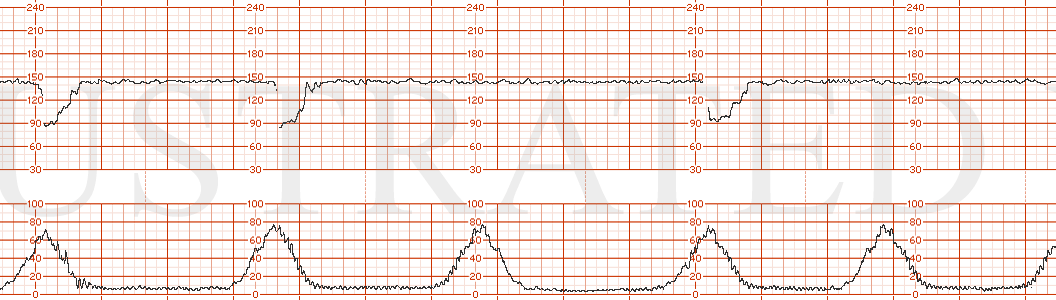 STRIP 122 1. Baseline 145, min variability, intermittent late decelerations. Toco: every 2-3 minutes