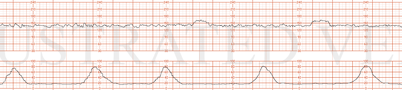 STRIP 123 1. Baseline 140s, mod variability, present accelerations Toco: every 3-5 minutes