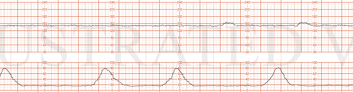 STRIP 124 1. Baseline is 140s, minimal variability, occasional accelerations. Toco: every 3-5 minutes