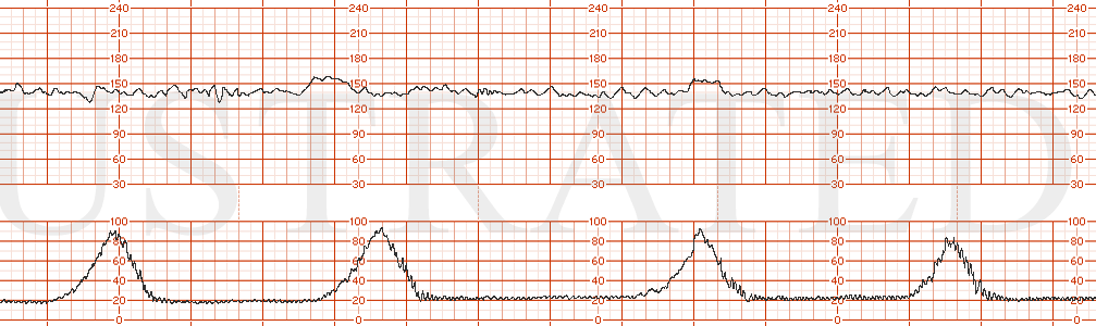 STRIP 125 1. Baseline 140, mod variability, presence of accelerations. Uterine contractions every 3-5 minutes.