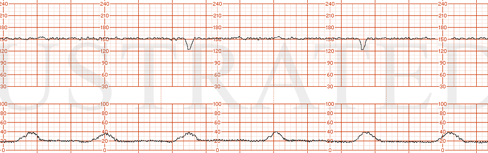 STRIP 126 1. FHR is in the 150s with minimal variability and occasional decelerations. Uterine activity is every 1-2 minutes, low amplitude.
