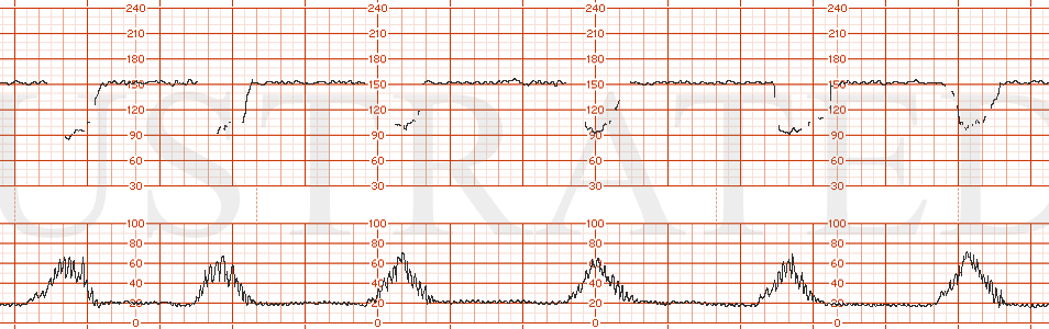 STRIP 127 1. FHR is in the 150s with minimal variability and occasional decelerations. Uterine activity is every 1-2 minutes, low amplitude. Then changes so toco every 2 minutes. With pushing, get intermittent loss of the tracing—but there are deep …