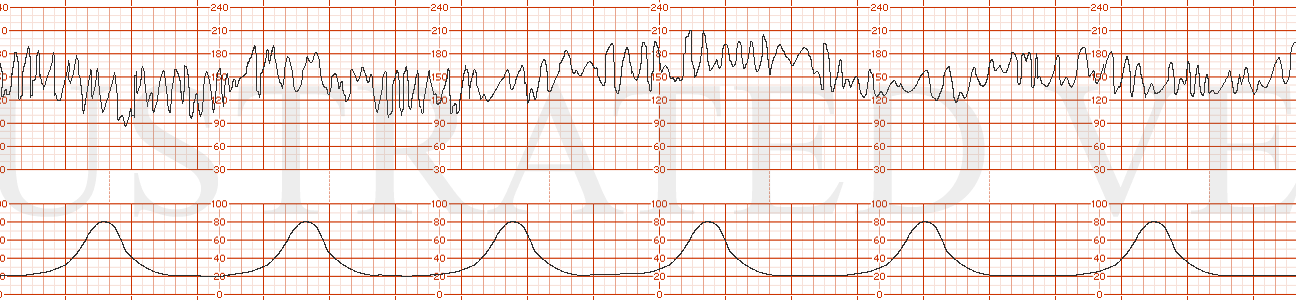 STRIP 128 1. Baseline 160s, with marked variability. Toco: every 2-3 minutes