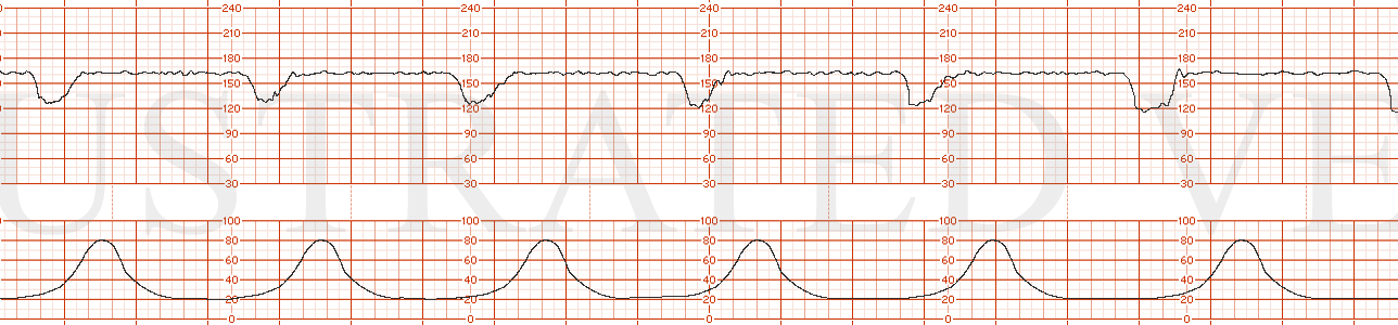 STRIP 129 1. 160s minimal variability, worsening early decelerations toco: as above