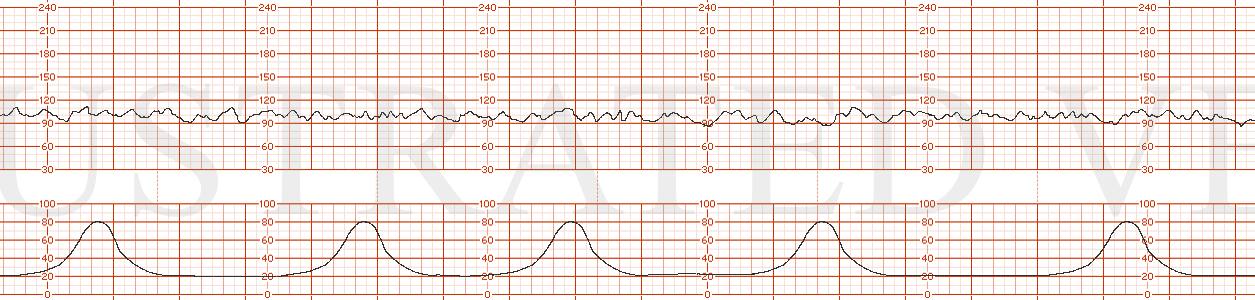 STRIP 130 1. Baseline 110, moderate variability, but no true accelerations. Toco: every 3-4 minutes