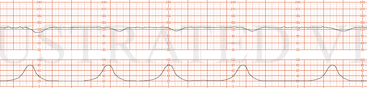 STRIP 131 1. 130s, minimal variability, occasional accelerations. Toco: as above