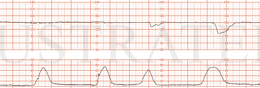 STRIP 136 1. Strip shows baseline 150 min variability, no accels, one contraction seen on toco lasting one minute followed by a late deceleration