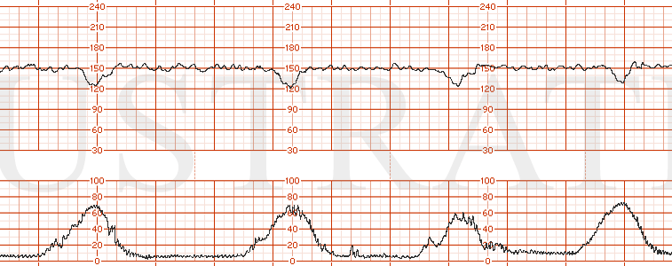 STRIP 140 1. Category 2 EFM strip showing moderate variability, normal uterine activity with contractions occurring every 3 minutes, and recurrent moderate variable decelerations