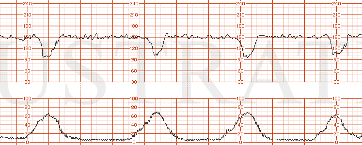 STRIP 141 1. Same strip as Strip 140, but with the recurrent variable decelerations extending to 30 bpm below the fetal baseline.