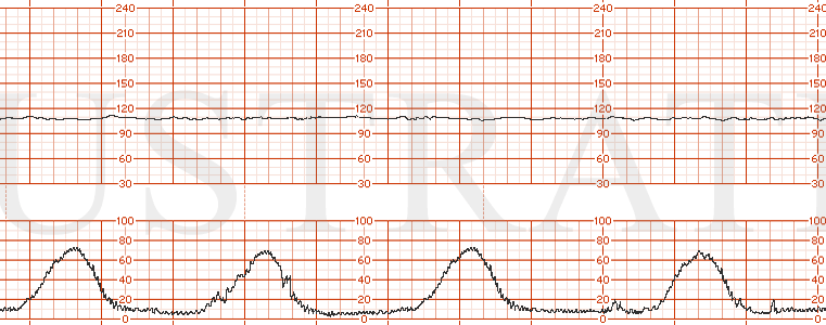 STRIP 144 1. Same as Strip 143 but with a baseline shift to 100 bpm with now absent baseline variability over the next 20 minutes.