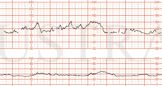STRIP 145 1. Bradycardia, FHR 95 bpm, moderate variability, accelerations