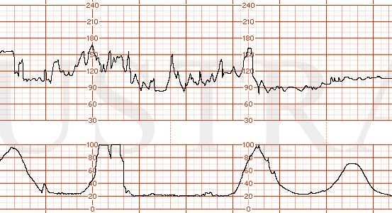 STRIP 147 1. Bradycardia, minimal to marked variability