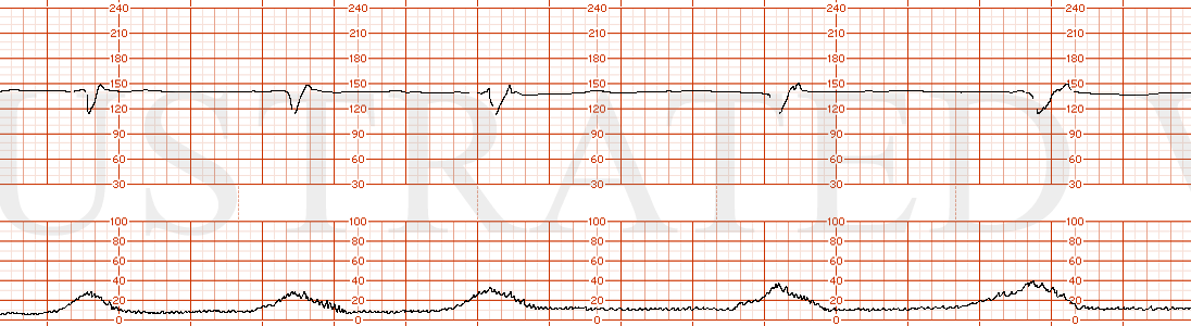 STRIP 148 1. Baseline 140, minimal variability with recurrent variable decelerations