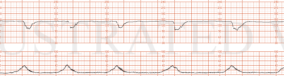 STRIP 149 1. category II – baseline 140, minimal variability with recurrent variable decelerations. Tracing is worsening category II---periods of min and mod variability and now recurrent late decelerations