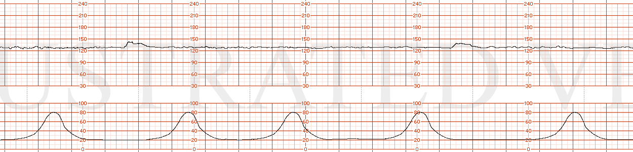 STRIP 150 1. 130s, minimal variability, occasional accelerations.