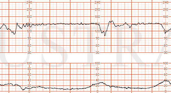 STRIP 151 1. Moderate variability, FHR 145, recurrent variable decelerations.