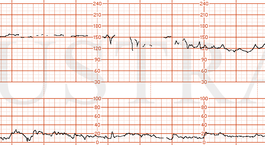STRIP 154 1. Unable to determine FHR baseline in first strip. Variable decelerations with nadir to 75-80, contractions every minute. Also another strip showing FHR 150 with minimal variability, and then uncertain FHR or possibly maternal heartrate.