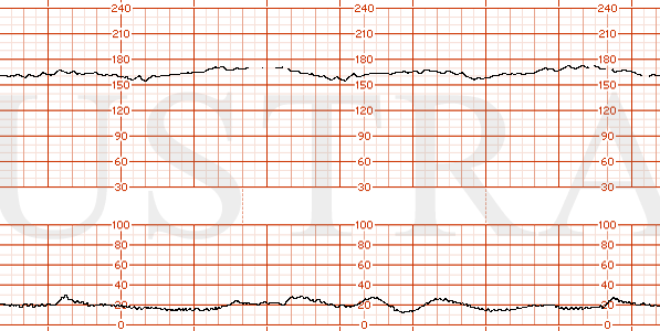 STRIP 155 1. FHR 170, minimal variability, late decelerations