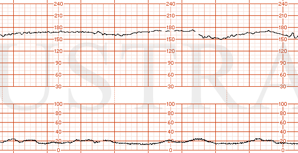 STRIP 156 1. FHR baseline 170, minimal variability, late decelerations