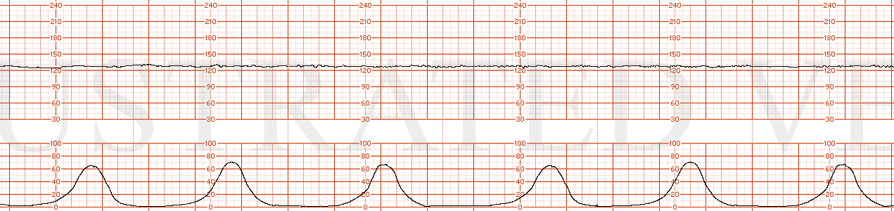 STRIP 159 1. Category 2 EFM strip with absent baseline variability, no  decelerations, and normal uterine activity with contractions occurring every 2 minutes.
