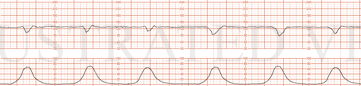 STRIP 160 1. Category 3 EFM strip with absent baseline variability, recurrent variable decelerations, and normal uterine contractions occurring every 2 minutes.