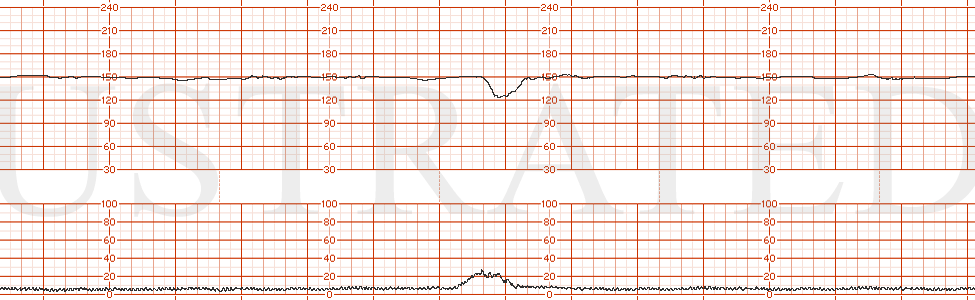 STRIP 161 1. baseline 150 min variability, no accels, one contraction seen on toco lasting one minute followed by a late deceleration