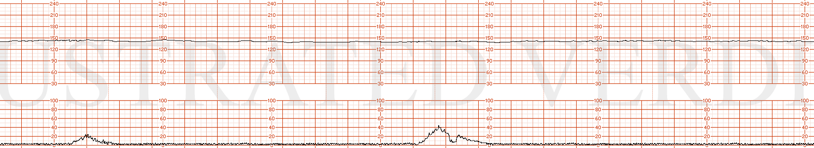 STRIP 164 1. Category 2 tracing, 20 minute chunk, 145 bpm baseline, minimal variability, no accels, no deccels, irregular contractions approx every 10 minutes.