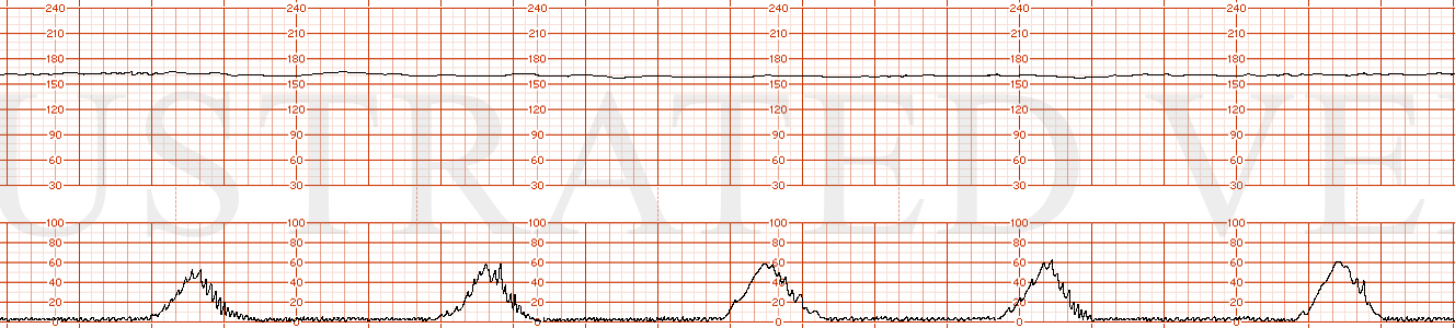 STRIP 165 1. Fetal heart tones 160s, minimal variability, no accelerations, no decelerations, contractions every 3-4 minutes, category II, 10-minute chunk