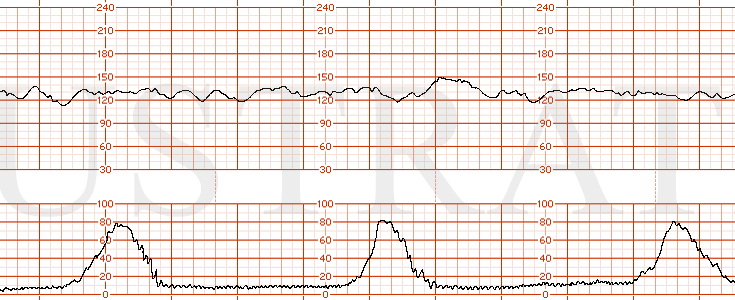 STRIP 166 1. Category I EFM strip showing a baseline of 130s with moderate variability, normal uterine activity with contractions occurring every 3 minutes and no decelerations. The strip should contain elevations in the heart rate that are less tha…