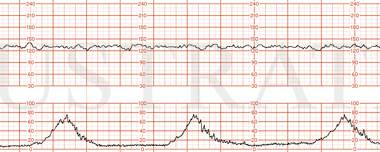 STRIP 167 1. Category I EFM strip showing a baseline of 130s with moderate variability, normal uterine activity with contractions occurring every 3 minutes and no decelerations. The strip should not contain any accelerations.