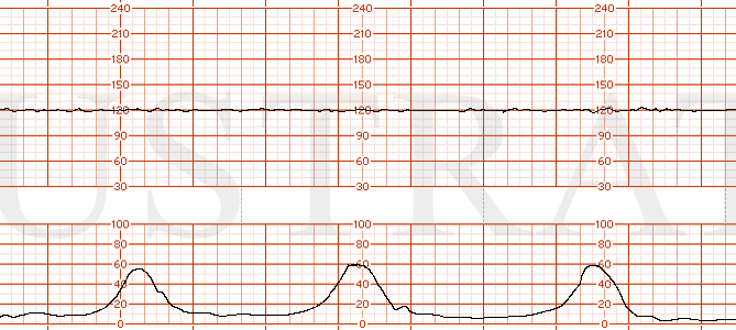 STRIP 168 1. Category II EFM strip showing a baseline of 120s with minimal variability, normal uterine activity with contractions occurring every 2 minutes and no decelerations.
