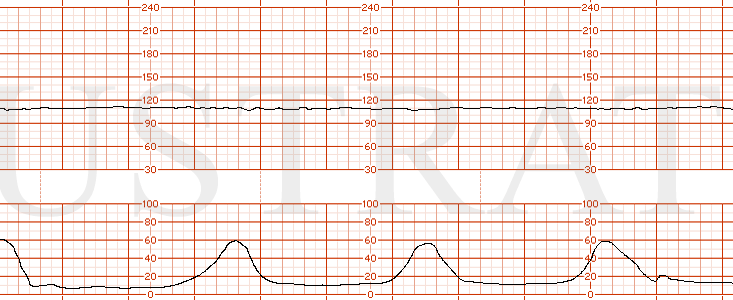 STRIP 169 1. Same as Strip 168 with a baseline shift to 100 bpm.