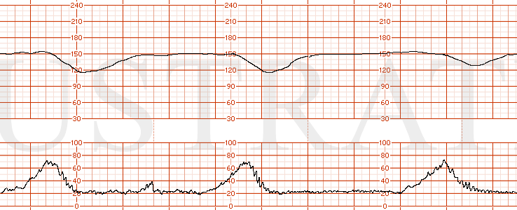 STRIP 170 1. Category III EFM strip showing a baseline of 150s with absent variability, normal uterine activity with contractions occurring every 3 minutes and recurrent late decelerations.