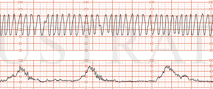 STRIP 171 1. Category III EFM strip showing a baseline of 150s with minimal variability, normal uterine activity with contractions occurring every 3 minutes and a sinusoidal pattern