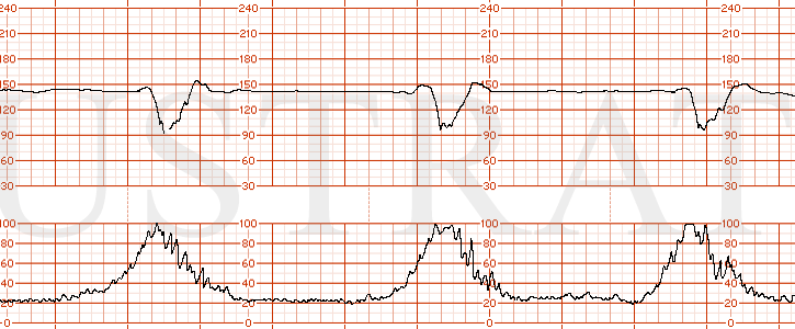 STRIP 172 1. Category III EFM strip showing a baseline of 150s with absent variability, normal uterine activity with contractions occurring every 3 minutes and recurrent variable decelerations.