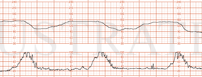 STRIP 173 1. Category III EFM strip showing a baseline of 150s with absent variability, normal uterine activity with contractions occurring every 3 minutes and the start of a prolonged deceleration to 80 bpm.
