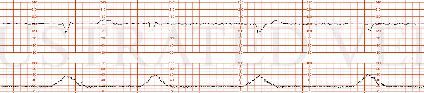 STRIP 174 1. 150s baseline with minimal variability (0-4) and moderate recurrent variable decelerations with one 10 bpm by 10 seconds acceleration and one 15 bpm by 15 bpm acceleration. Contractions are every 3 minutes. Normal contractions. Category…