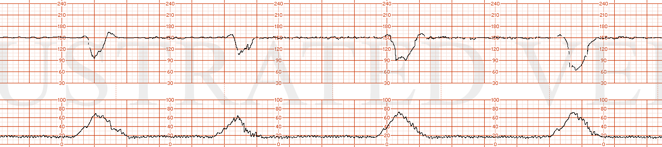 STRIP 175 1. 150s baseline with minimal variability (0-4) and moderate recurrent variable decelerations and one severe variable deceleration. Contractions are every 3 minutes. Normal and Category II trending to III with 20 minutes of tracing.
