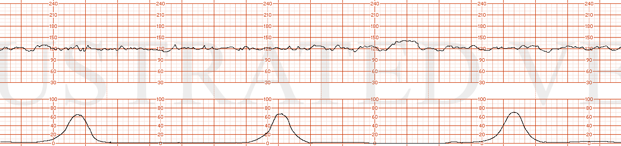 STRIP 176 1. Baseline of 120s with moderate variability. The tracing has accelerations with mild (quantification previously addressed) variable decelerations lasting 15 seconds to 90 bpm with contractions. Contractions are every 5 minutes and normal…