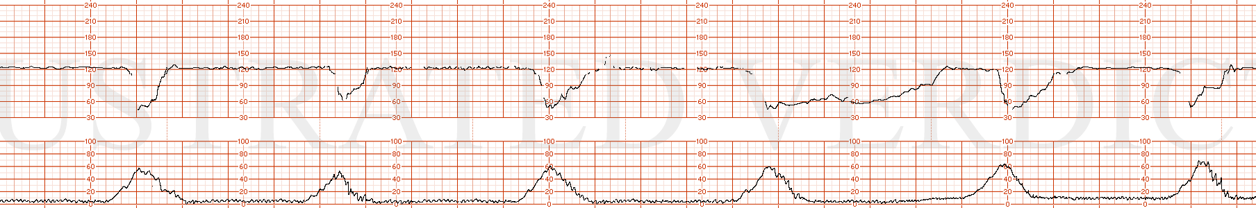 STRIP 177 1. Minimal variability with recurrent variable decelerations which are dipping to 60 bpm and lasting 30-40 seconds and one variable deceleration to the 60’s lasting 1 minute and one prolonged deceleration lasting 4 minutes to 40 bpm. Contr…