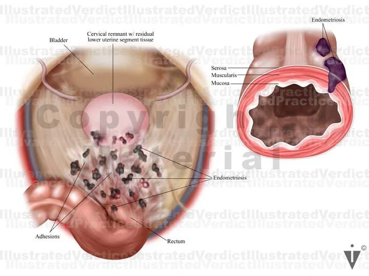 Female Abscess Stock Female Pelvis: Endometriosis / Pelvic Inflammatory Disease ...