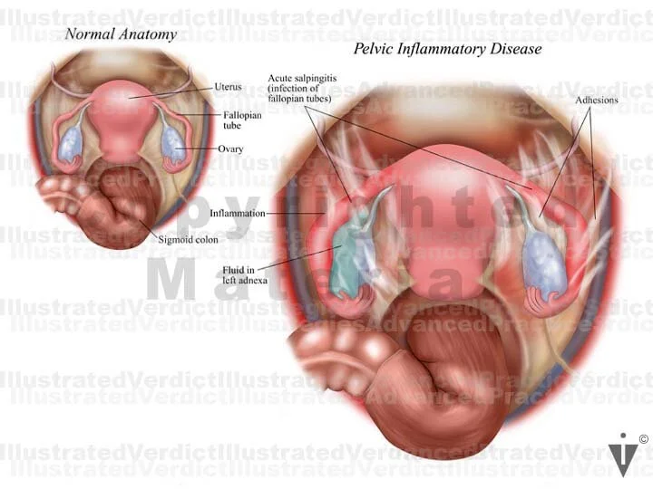 Female Abscess Stock Female Pelvis: Endometriosis / Pelvic Inflammatory Disease ...