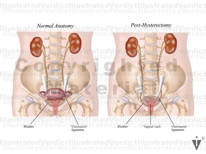 Stock Female Pelvis Bladder Ureter Injuries Illustrated Verdict