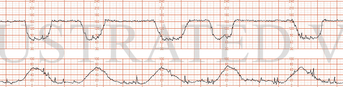 STRIP 180 1. 15 min of baseline in 150s with minimal variability. Recurrent variable decelerations with nadir of 70 bpm lasting 1-2 min) 703_lo4_md_sct_q076 (example from Panel B); modifications (variable decels need last >1 min but <2 min on …