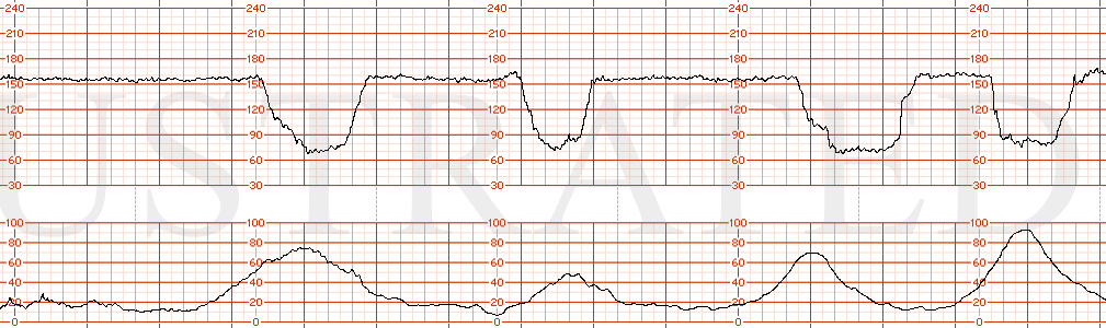 STRIP 181 1. Baseline in 160s with minimal variability. Recurrent variable decelerations lasting > 60-90 seconds with nadir 70-80 bpm)