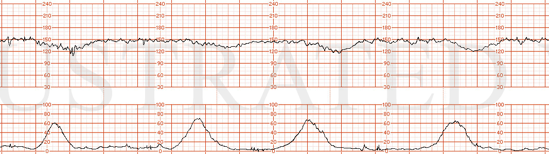 STRIP 182 1. 1. 15 min of tracing; Baseline in 150s with moderate variability. Recurrent late decelerations (decelerations occur with > 50% of the contractions) with nadir about 30 bpm below baseline). Contractions are q3-4 min on average; normal…