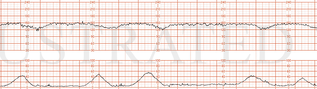 STRIP 183 1. 15 min strip: Baseline in 150s with moderate variability. Recurrent late decelerations with decrement 15-20 bpm below baseline