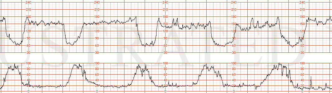 STRIP 184 1. Baseline in 150s with moderate variability and recurrent variable decelerations with nadir of 60 bpm lasting 1-2 min)